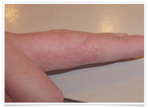 Truelipids Eczema Complete Care Eczema Treatment Eczema Healthy Skin