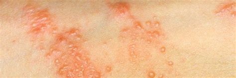 What Are Symptoms And Treatment Of Poison Ivy Rash Endomedcare