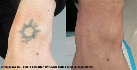 Laser Tattoo Removal In New Jersey Soma Skin And Laser