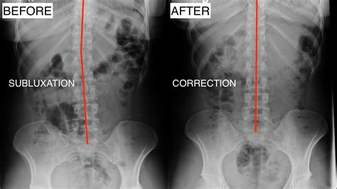 The problem with lower back pain rehabilitation. Results with Corrective Chiropractic Care - Abundant ...