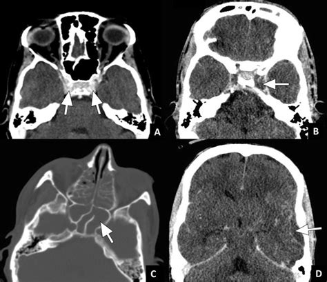 Cavernous Sinus Thrombosis Case 1 A Axial Cect Image In A Soft Tissue