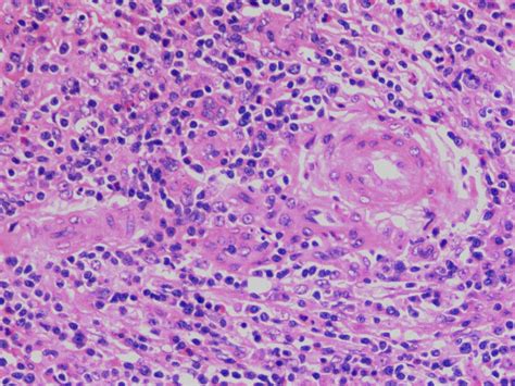 Unusual And Rare Case Of Generalised Lymphadenopathy Kimuras Disease