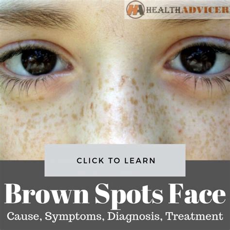 Brown Spots On Face Causes Picture Symptoms And Treatment