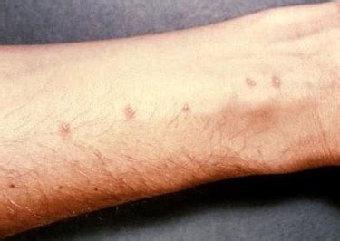 How to Get Rid of Swimmers Itch: Pictures, Signs and Treatment Tips
