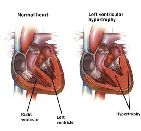 Cardiomegaly Causes Treatment Symptoms Pictures Types