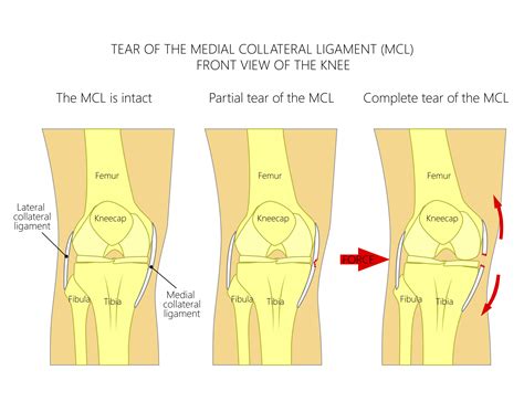 Mcl Injury Treatment Medial Collateral Ligament Injury Surgery In