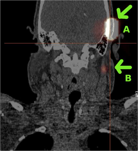 Surgical Evaluation Of The Use Spect Ct In Sentinel Lymph Node Biopsies