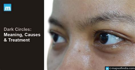 Dark Circles Meaning Causes And Treatment Lifestyle