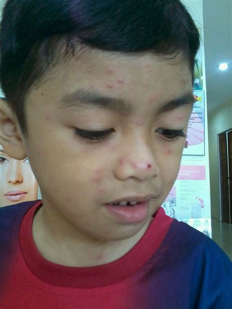 Chickenpox is a highly contagious infection that causes an itchy, spotty rash. ibuveronza: Demam Campak dengan Herba Blend
