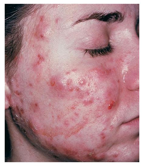 Huge Cystic Acne On Face Acnefree Reviews Is There A Cure For Acne