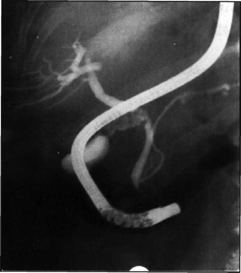 Ercp Showing Poorly Defined Cystic Duct Common Bile Du Open I