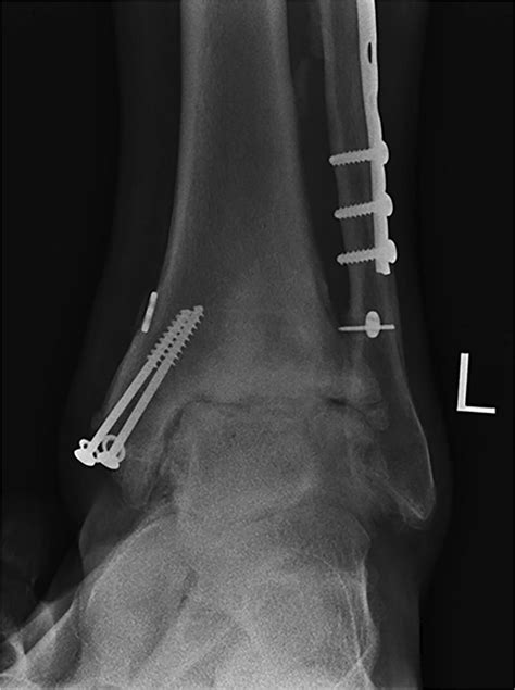 Anteroposterior Radiograph Of The Ankle Showing Advanced Osteoarthritis