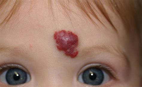 Strawberry Nevus And Other Birthmarks In Pictures Med