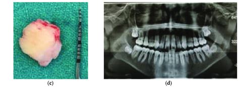 Example Of A Case Treated With Operculectomy A Pre Surgical Occlusal