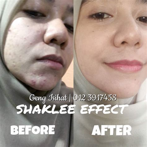 Kisah Shaklee Saya Muka Breakout Punca Kurang Keyakinan Diri Isihat