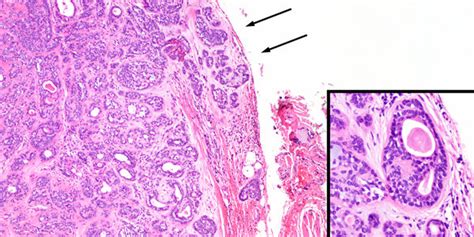 Minimally Invasive Carcinoma Ex Pleomorphic Adenoma A This Tumor Shows