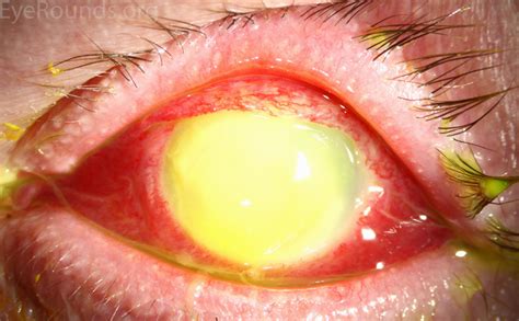 Keratitis is a condition in which the eye's cornea, the clear dome on the front surface of the eye, becomes inflamed. fungal keratitis