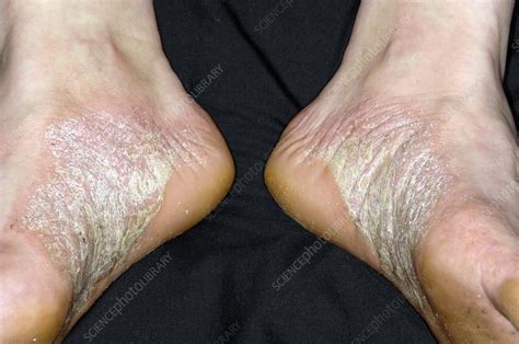 Acute Psoriasis On The Feet Stock Image C0042473 Science Photo Library