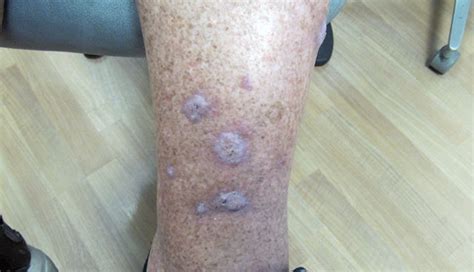 Thick And Keratotic Lesions On Both Shins Clinical Advisor