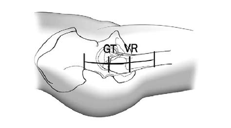 Illustration Of The Incision For Direct Lateral Approach Gt Tip Of