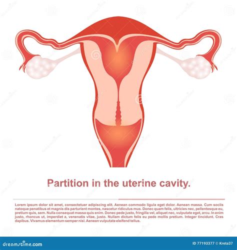 Uterine Septum Septate Uterus Female Reproductive System Front View Human Anatomy Internal