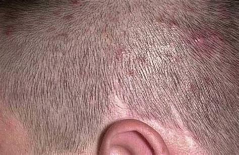 Scalp Folliculitis Pimples On Scalp Scalp Acne Scalp Acne Treatment