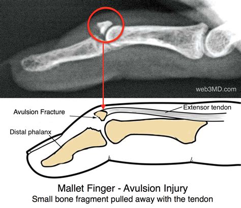 Mallet Finger Avulsion Fracture