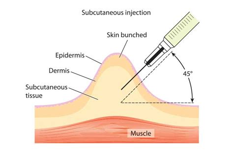 Subcutaneous Injections Support Under The NDIS Ausmed