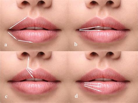 Lip Filler Techniques All You Need To Know