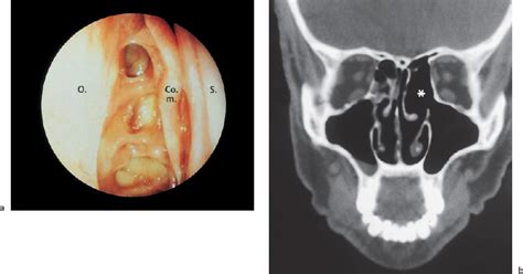 Results Of Endoscopic Sinus Surgery Personal Experience Ento Key