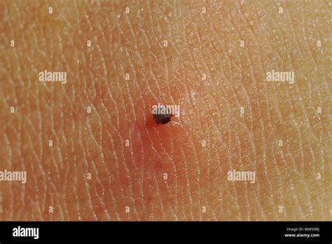 Small Ixodidae On Human Skin Sucking Blood Tick Parasit Biting Macro