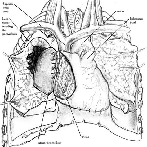 Pericardial Reconstruction In Thoracic Surgery Ctsnet