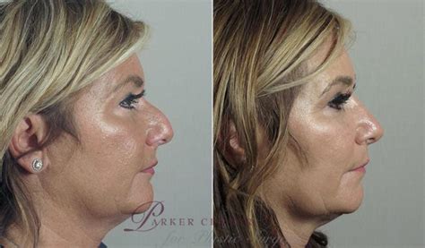 Rhinoplasty Before And After Pictures Case 194 Paramus Nj Parker