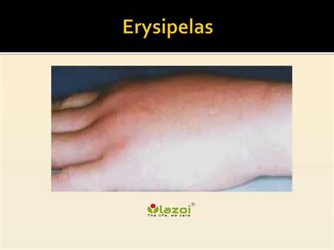 Ppt Erysipelas Symptoms Causes Diagnosis And Treatment Powerpoint