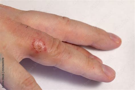 Hand Dermatitis Finger Eczema Stock Photo Adobe Stock