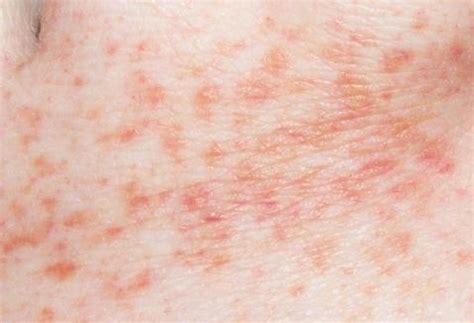 Treten die roten punkte am ganzen körper auf oder kommt es beispielsweise lediglich zu roten flecken im gesicht, am bein oder am bauch? Rote Flecken auf den Füßen. Sind sie auf eine zu hohe ...