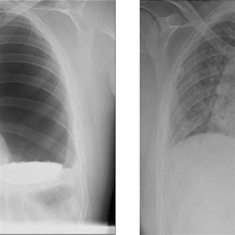 Chest X Ray At Initial Presentation Left And Post Left Intercostal