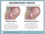 Cervical Cancer During Pregnancy Treatment