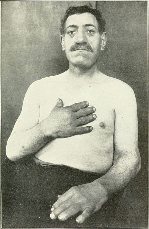 Acromegaly Almostadoctor