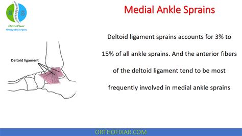 Medial Ankle Sprains Easy Explained Orthofixar 2022 Ankle Fracture