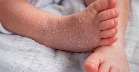 Newborn Skin Peeling 7 Tips To Manage Newborn Skin Peeling Bellybelly