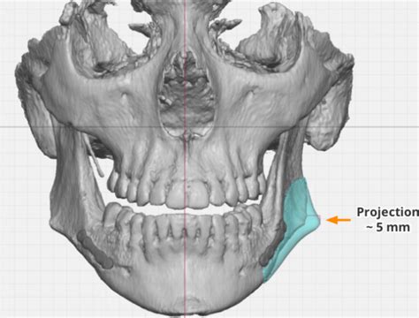 Custom Left Jaw Angle Implant Dimensions Front View Dr Barry Eppley