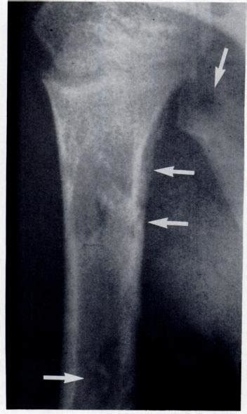 Radiograph Of Shoulder Shows Multiple Eosinophilic Granuloma Lesions