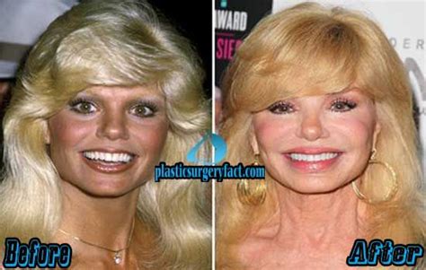 Pin On Celebs Plastic Surgery Before And After