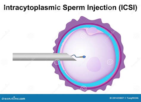 Intracytoplasmic Sperm Injection Icsi Process Diagram Stock
