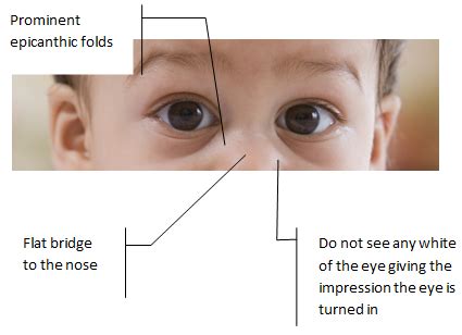 A flattened occiput, microcephaly, and extra skin around the back of the neck are common. Flat Nasal Bridge And Epicanthal Folds : Figure 4 From ...