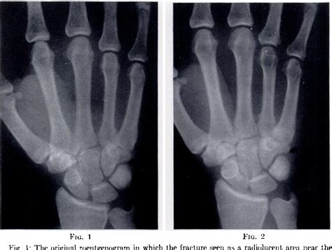 Figure 1 From Delayed Ulnar Nerve Palsy Following A Fracture Of The