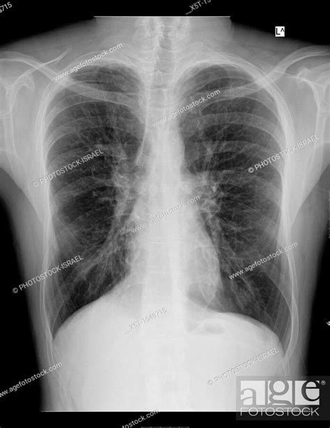Chest X Ray Of A 28 Year Old Male Patient Suffering From Dyspnea Due To