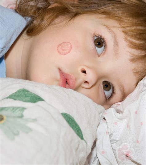 Ringworm In Kids Types Causes Symptoms Treatment And Care