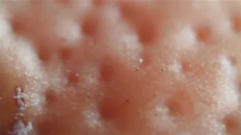 Scaly Skin Fungal Infection Of Skin Youtube